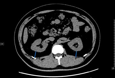 Perirenal Fat Thickness: A Surrogate Marker for Metabolic Syndrome in Chinese Newly Diagnosed Type 2 Diabetes